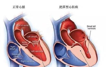 当心运动中的“猝死杀手”——肥厚型心肌病